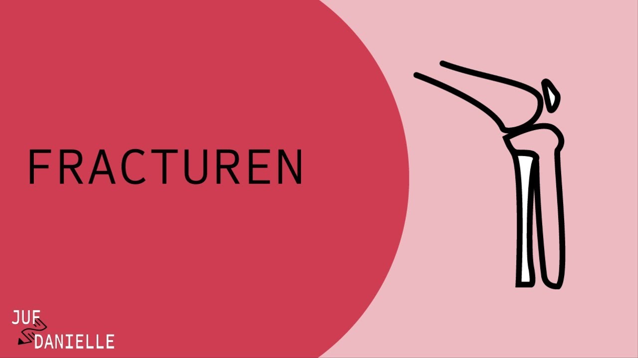 Fracturen
