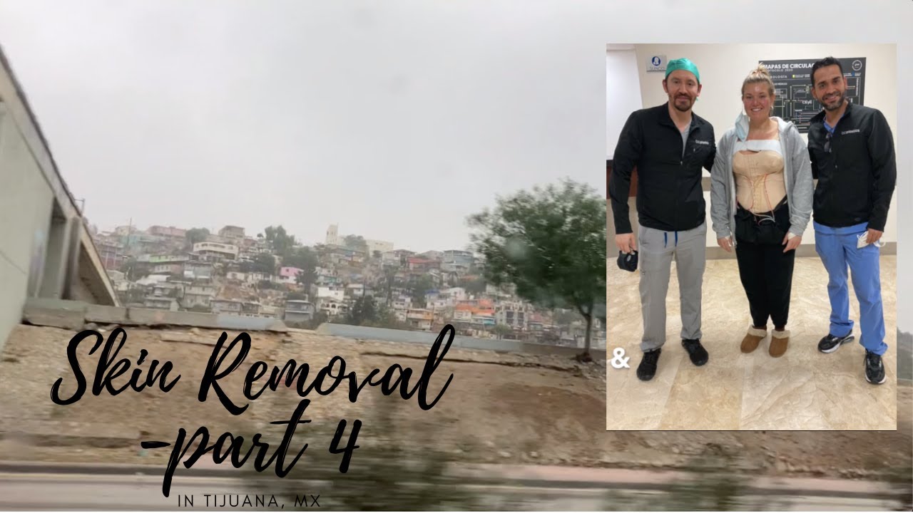 Skin Removal In Tijuana, Mexico-Part 4