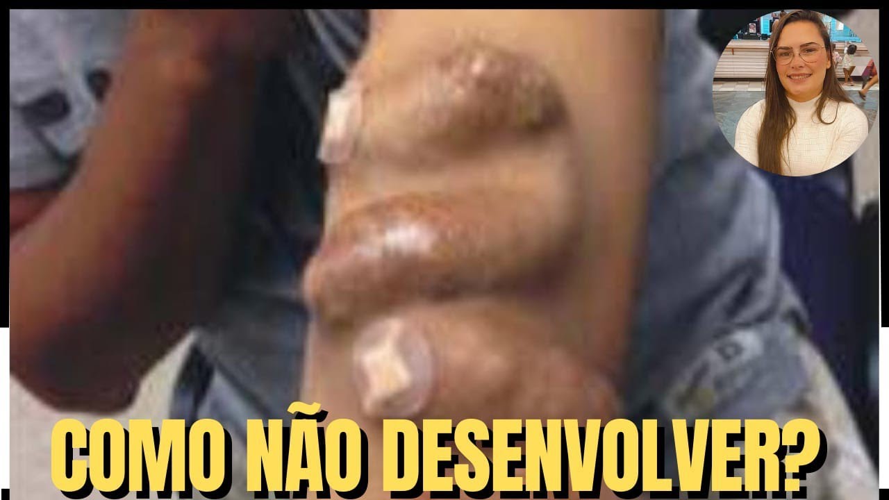 Como diminuir o risco de ter ANEURISMA na FÍSTULA ARTERIOVENOSA