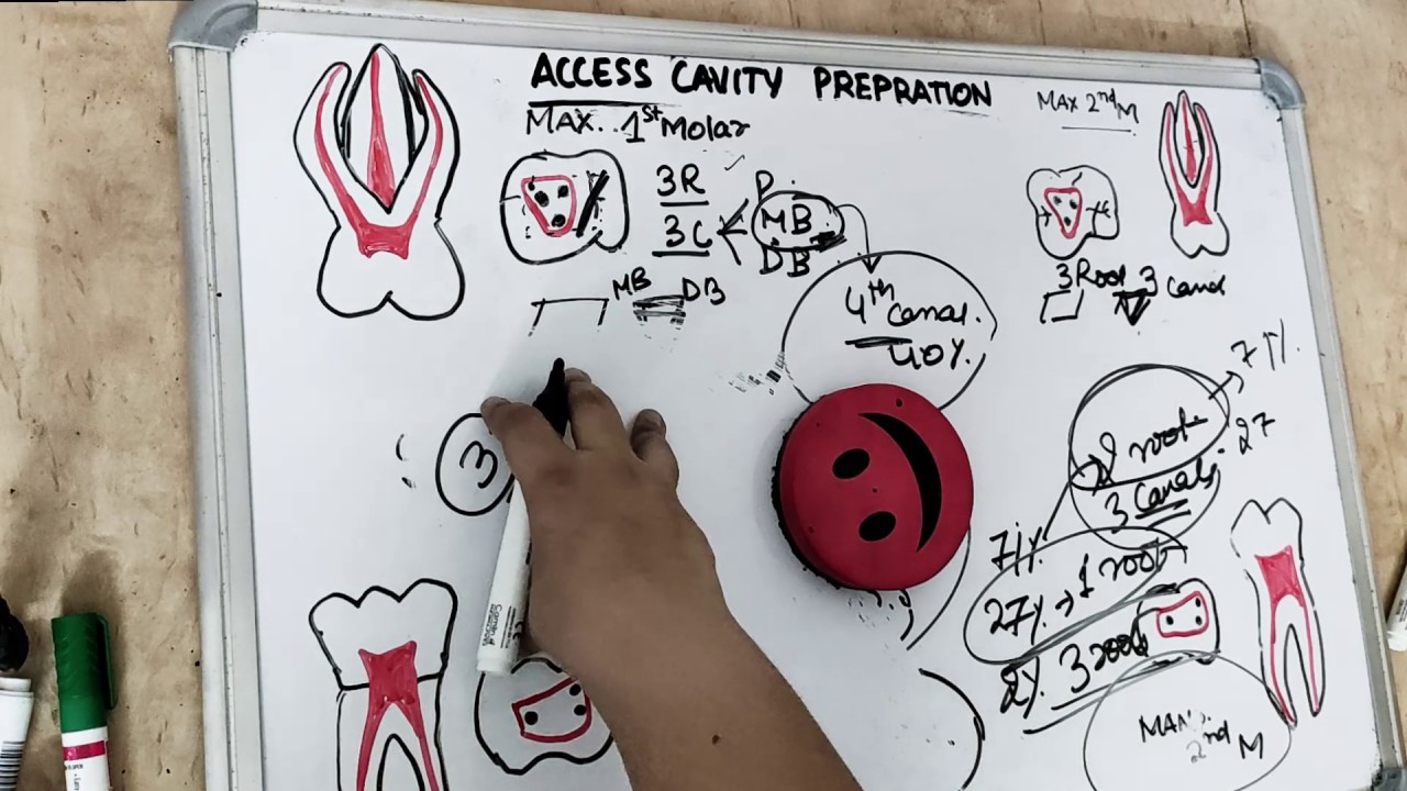 access cavity preparation - premolar & molar