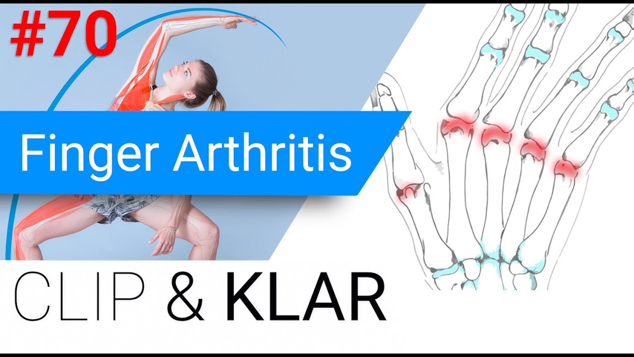 Finger Arthritis erkl&auml;rt - Rheumatoide Arthritis, Psoriasis und Co.