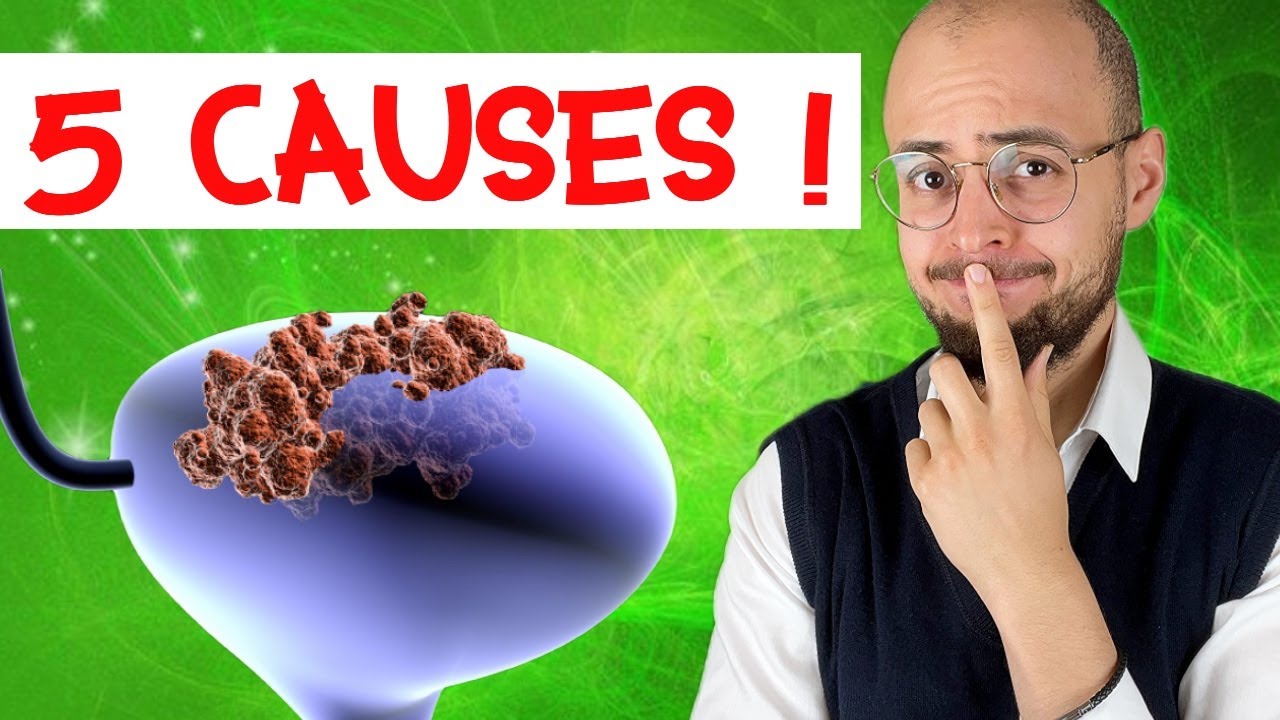 CANCER de la VESSIE : 5 grandes causes !