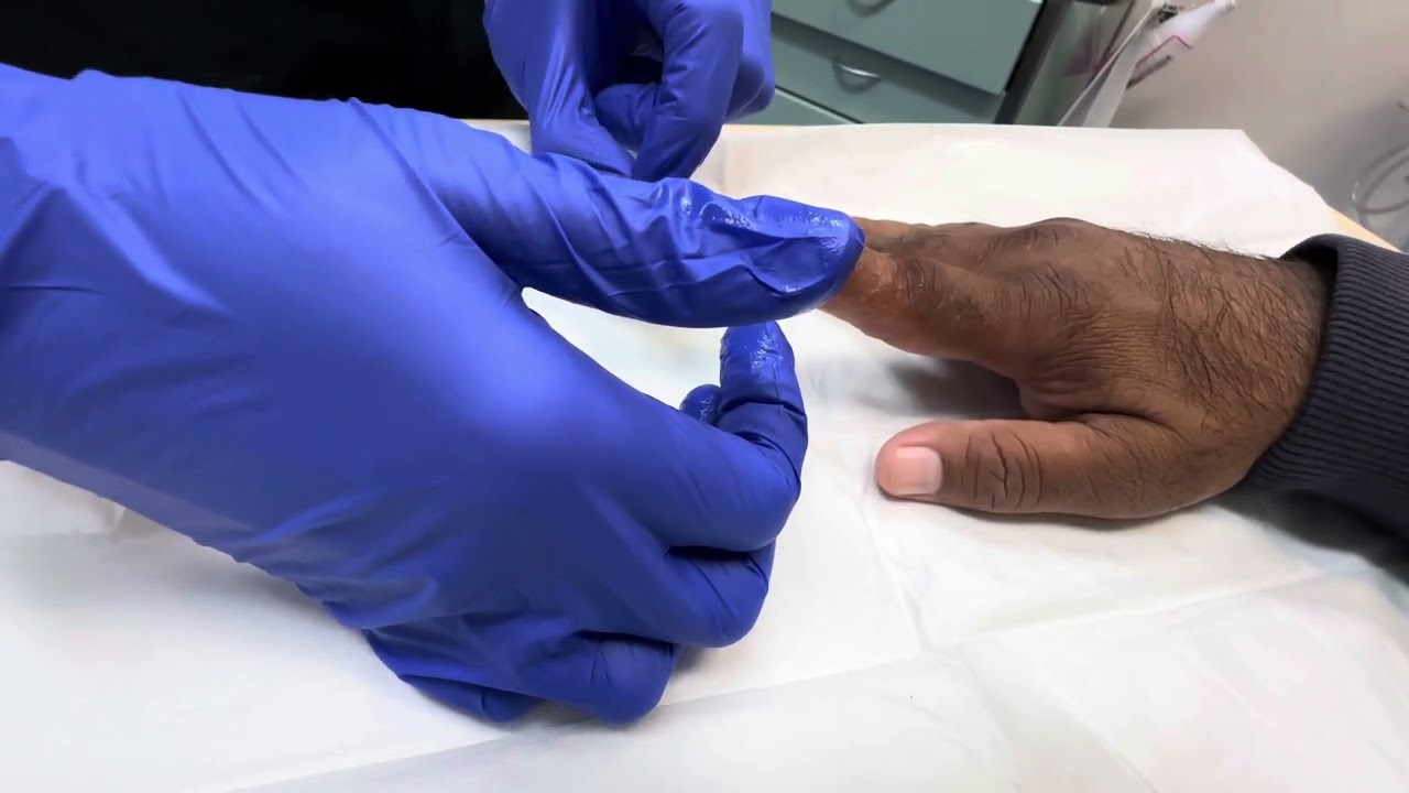 Broken Index Finger | Update cricket injury Avulsion Fracture | Post Surgery |Dressing broken finger