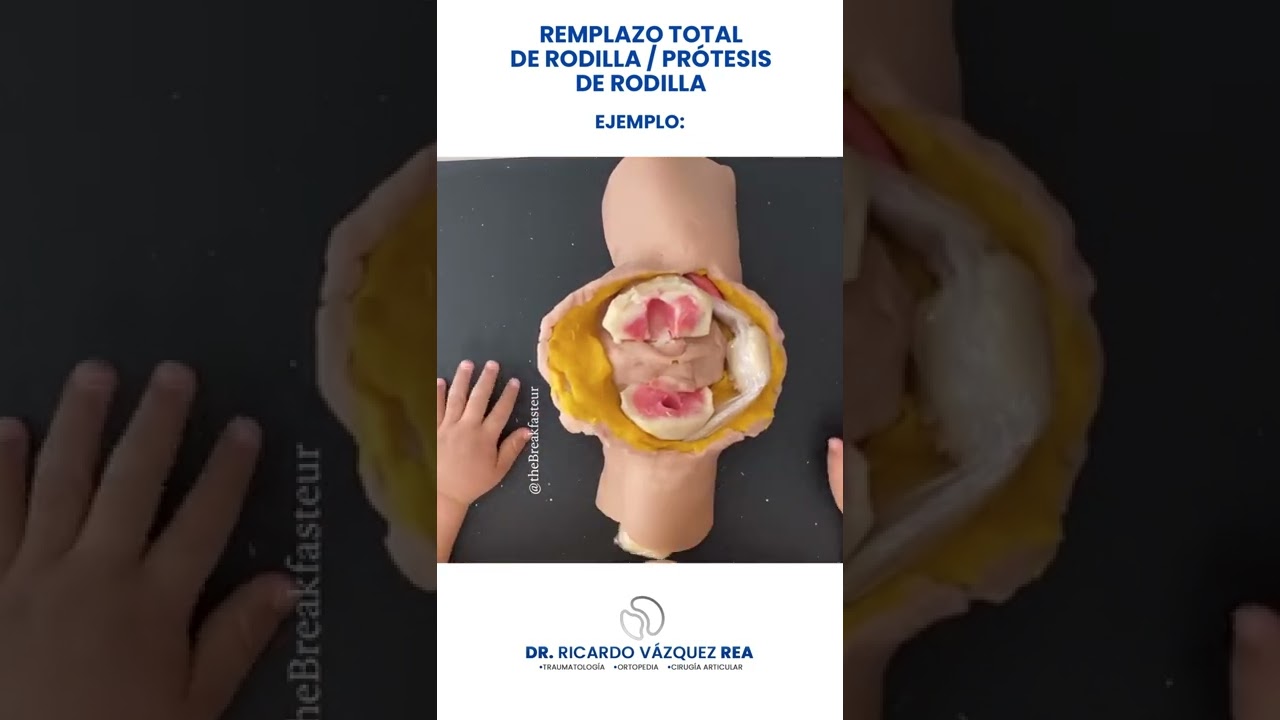 Así se realiza un remplazo total de rodilla / ejemplo de @thebreakfasteur 🦴🦵🏻