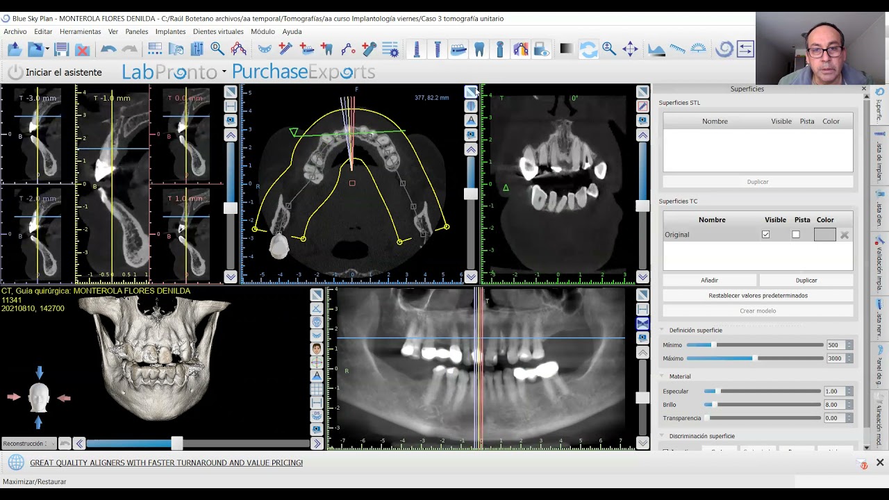 Blue Sky Plan Personalizando el arco maxilar y mandibular