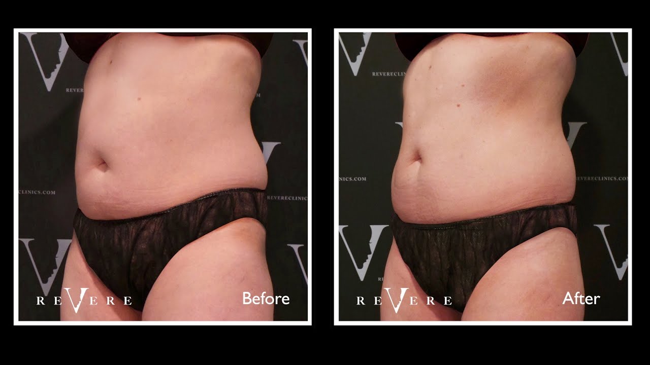 I Had My Fat Frozen Off! | CoolSculpting