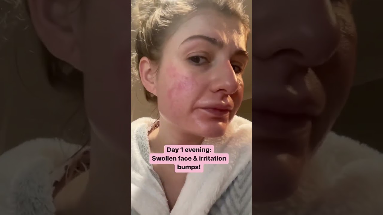 A cleanser gave me chemical burns, watch me heal my skin in 3 days with petroleum jelly! #skincare