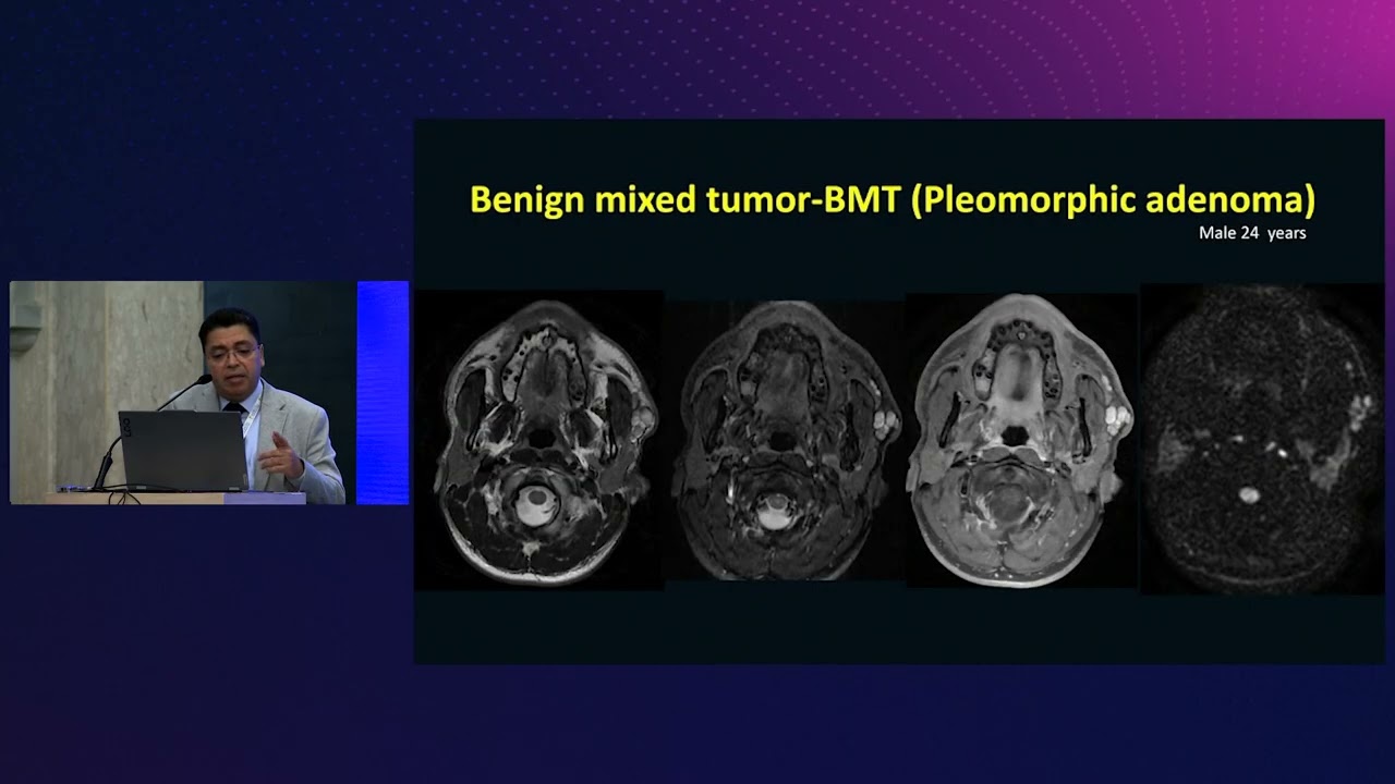 Imaging of salivary glands tumors