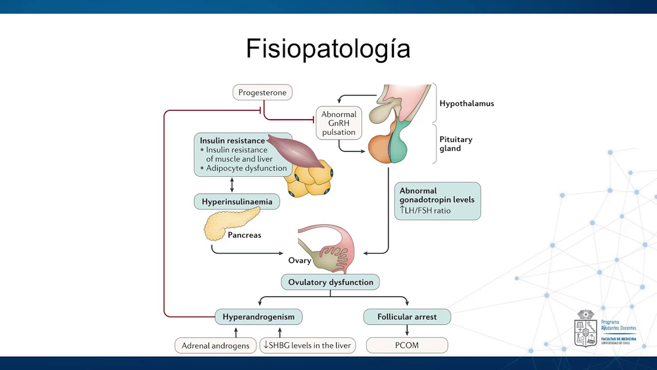 Fisiopatología Síndrome de Ovario Poliquístico