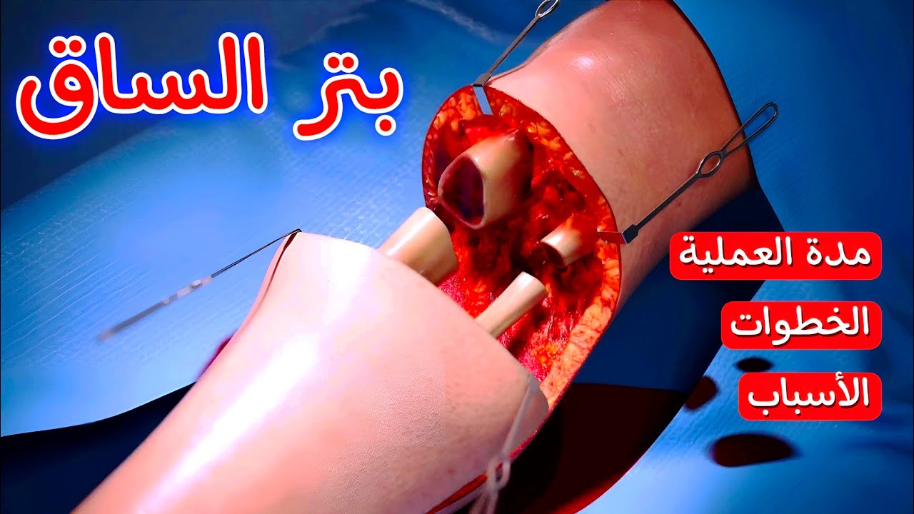 متى نقوم بقطع الساق (البتر) | شاهد خطوات عملية بتر الساق بالتفصيل 3d animation