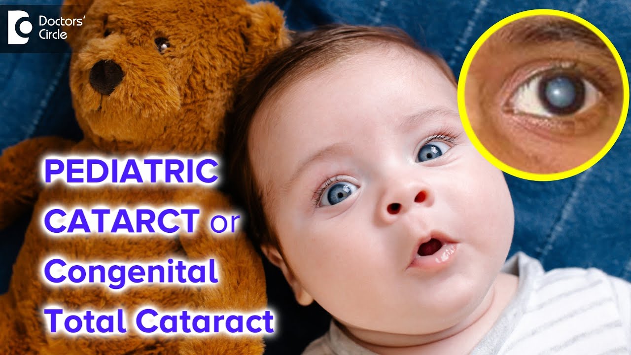 What is Congenital Total Cataract? | Pediatric Cataract - Dr. Sriram Ramalingam | Doctors' Circle