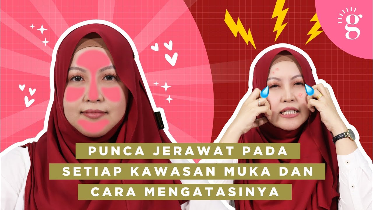 Punca Jerawat Pada Setiap Kawasan Muka Dan Cara Menghilangkannya