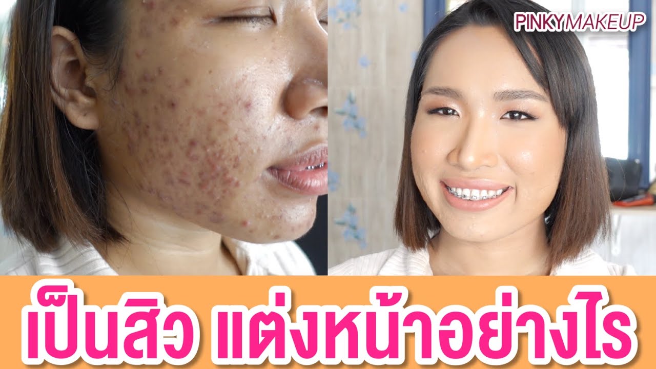 👍เป็นสิว แต่งหน้าอย่างไร?  | สอนแต่งหน้า อ.ปิงปอง Pinkymakeup