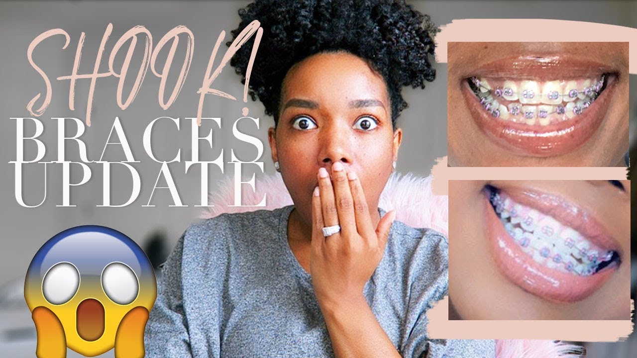 7 MONTH BRACES UPDATE!!!