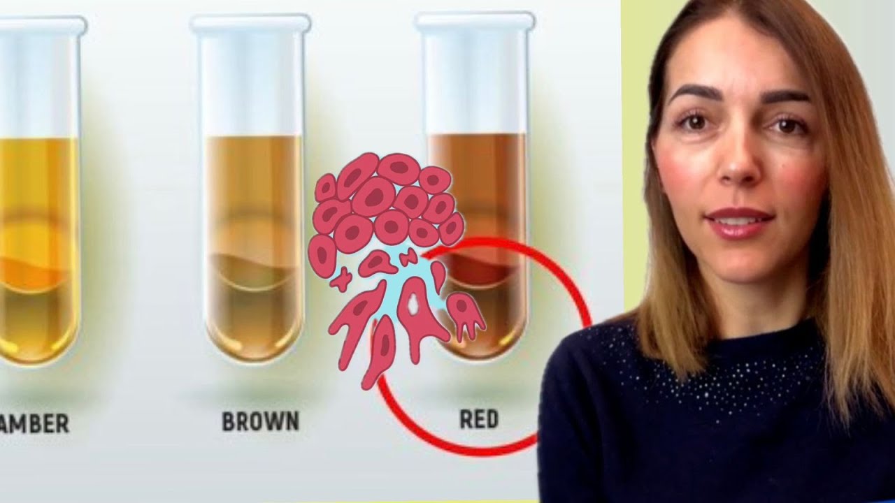 “Urina me ngjyrë të kuqe sinjal për tumor”, mjekja urologe shpjegon simptomat