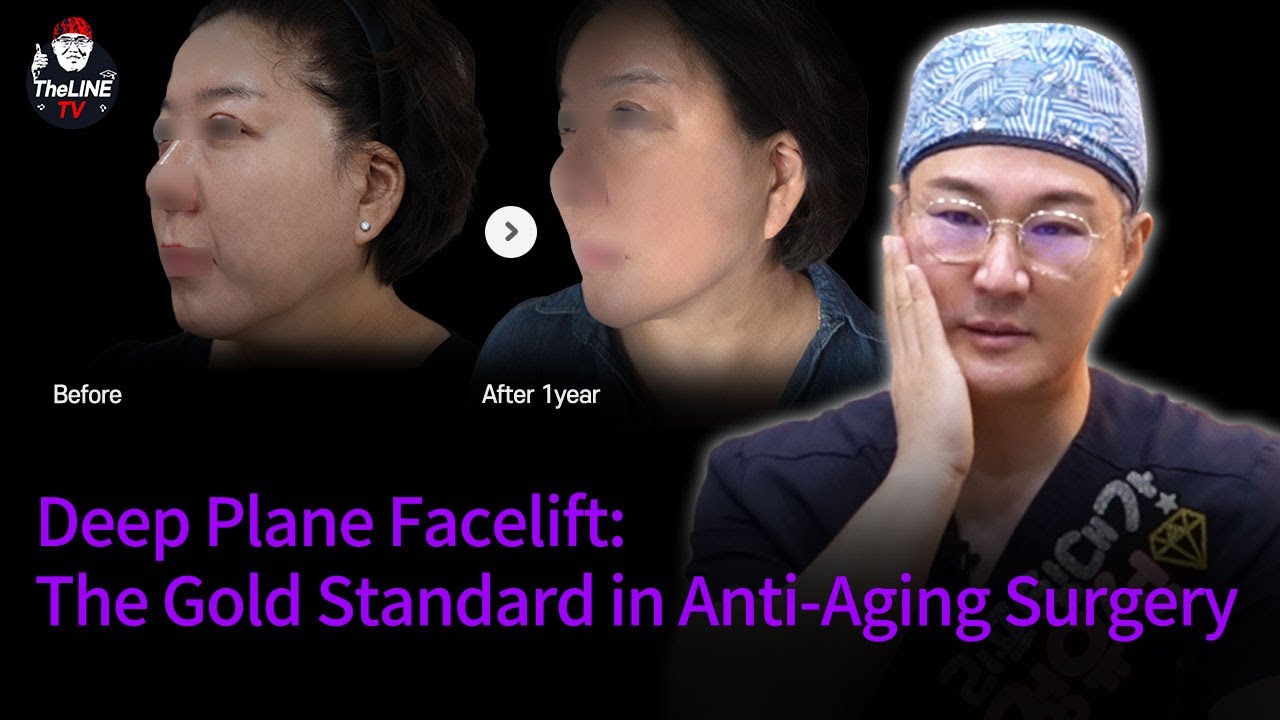 Deep plane Facelift #DeepPlaneFacelift #FacialRejuvenation #AntiAging