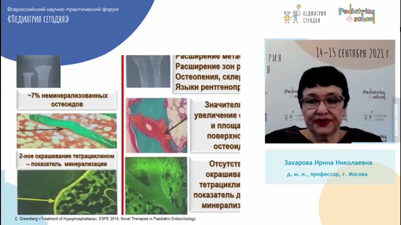 Гипофосфатазия
