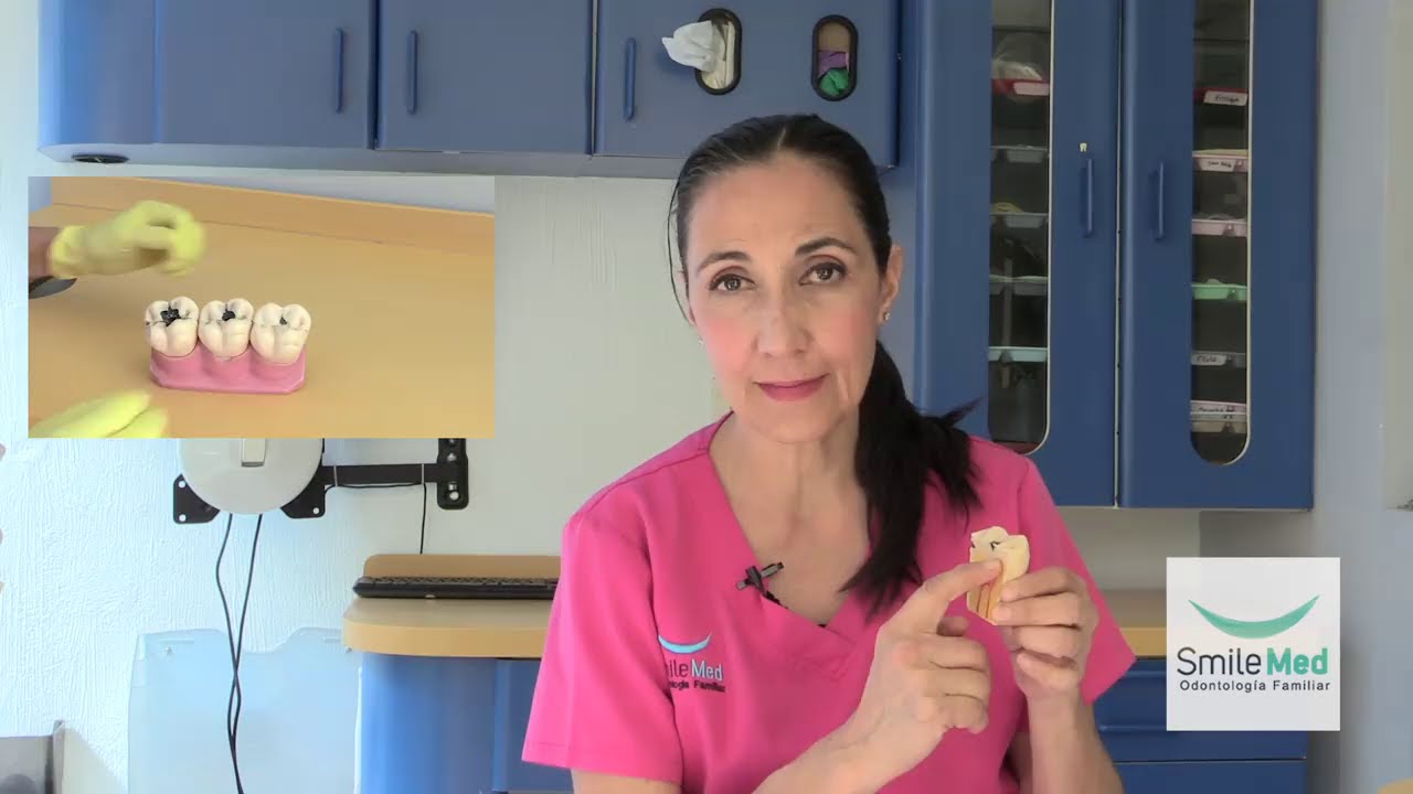 Grados de caries - Simle Med Clínica De Odontología En Guadalajara