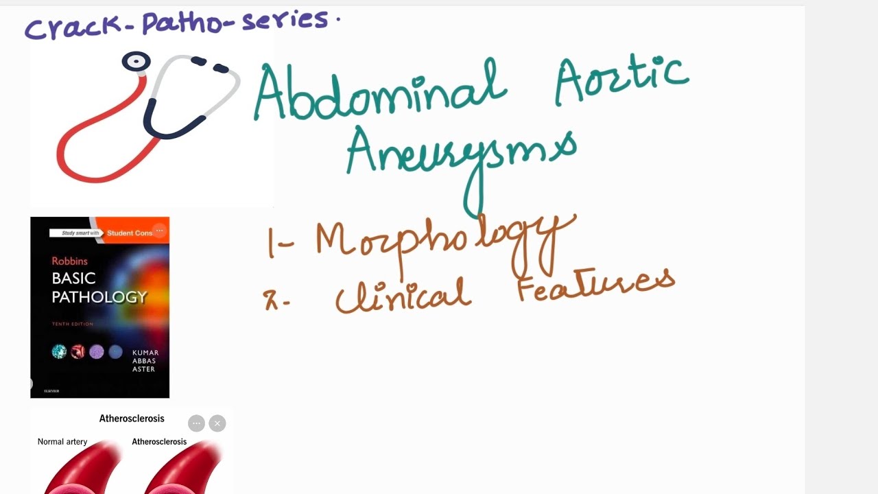 Aneurysm morphology part 2 made easy from robbins