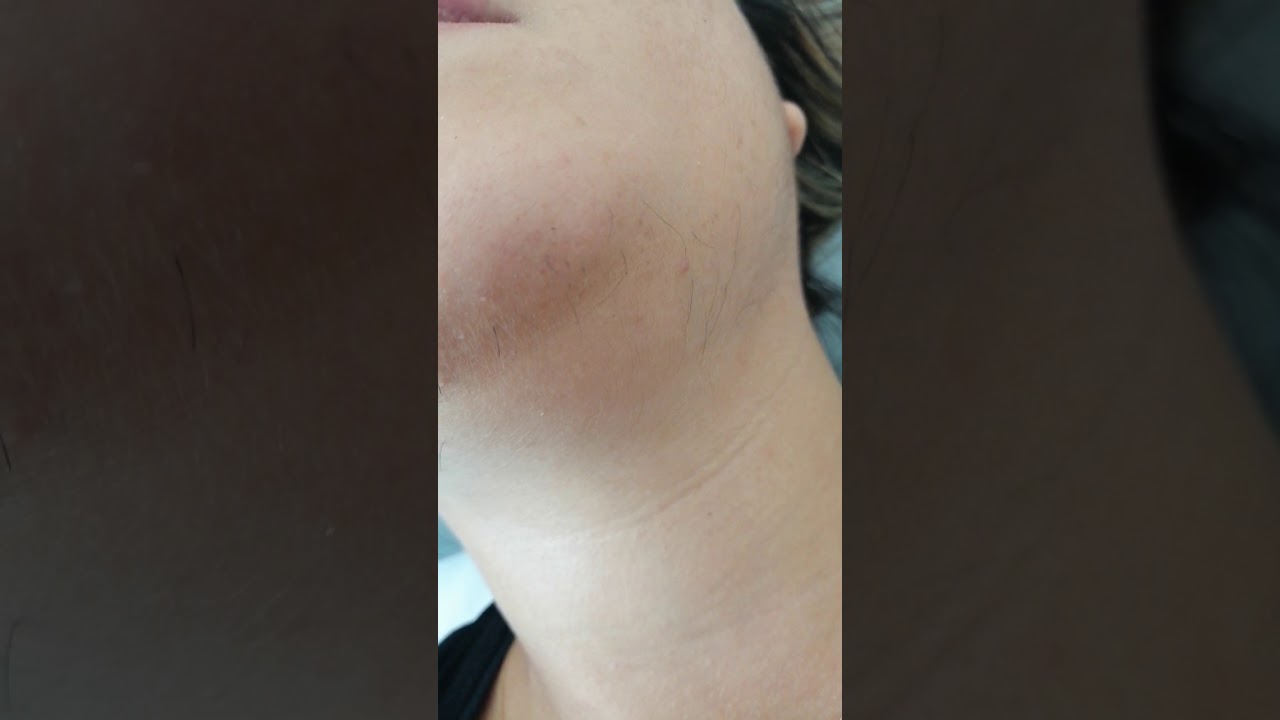 İğneli Epilasyon #iğneliepilasyonistanbul #lazerepilasyon #buzlazeristanbul#electrolysis