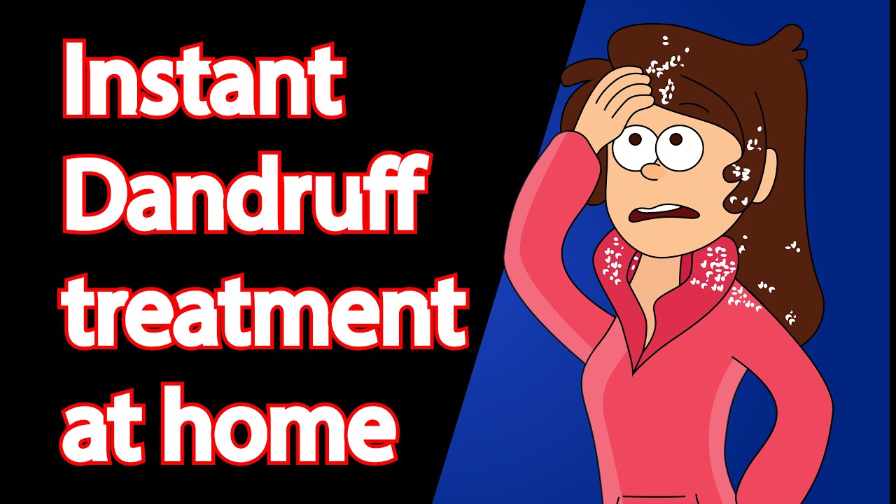 How to get rid of Dandruff quickly -Part 2 | Instant Dandruff treatment at home | 2021