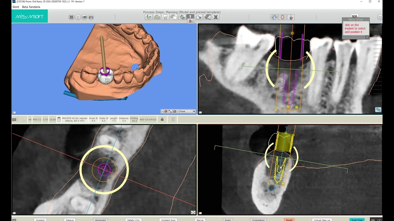 MSOFT Tutorial: Implant Design (Part 6)