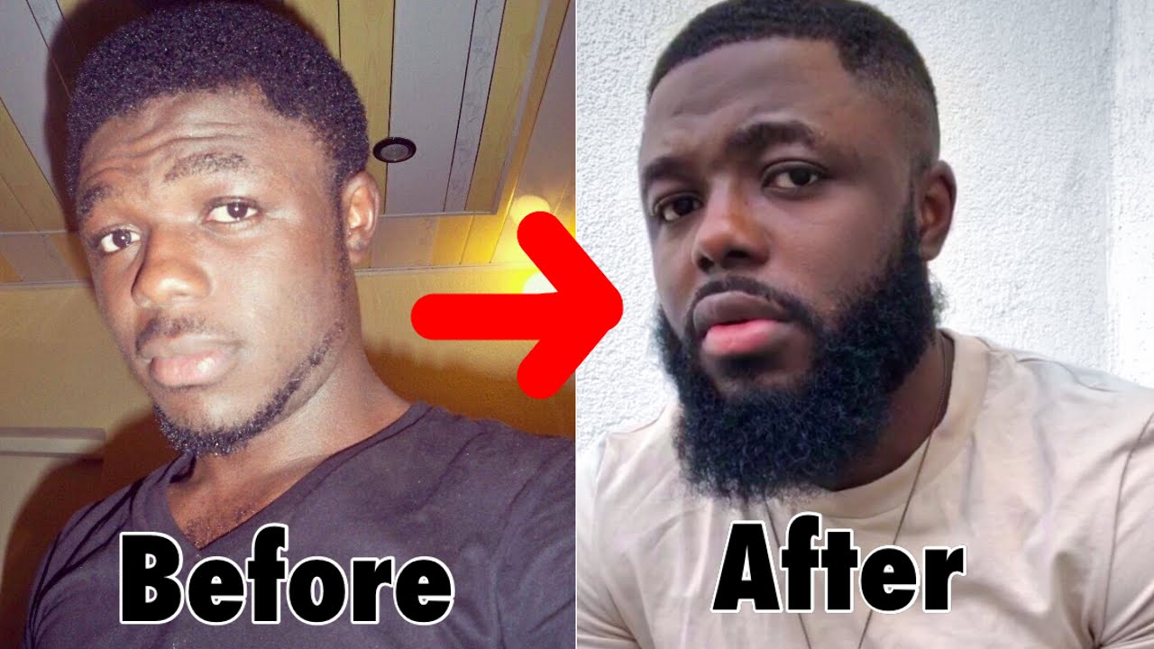 how i used A MINOXIDIL and a DERMA ROLLER to grow my BEARD.