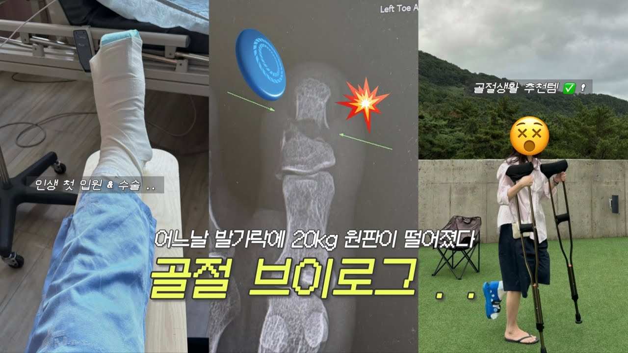 발가락 골절 브이로그..💥 입원부터 수술 그리고 회복 (ing) + 골절생활 추천템 🩼👩🏻‍🦽
