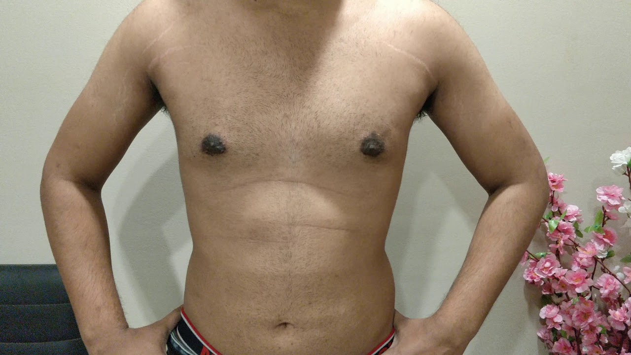 Gynecomastia result after 2 years !! Dr. Prashant Yadav