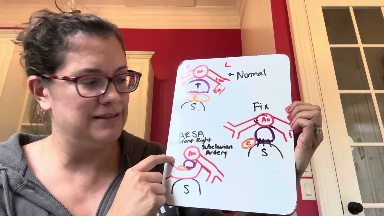My sons ARSA - Aberrant Right Subclavian Artery and path forward explained - for friends and family