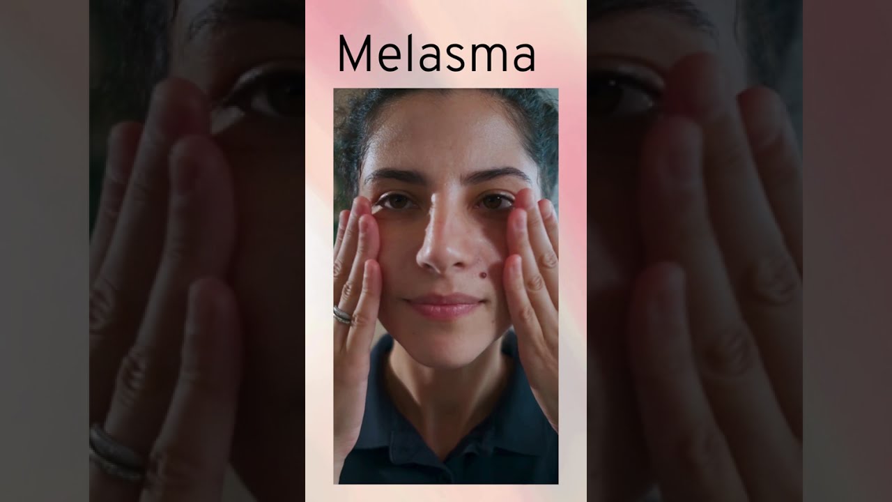 "Niacinamide vs Azelaic Acid? 