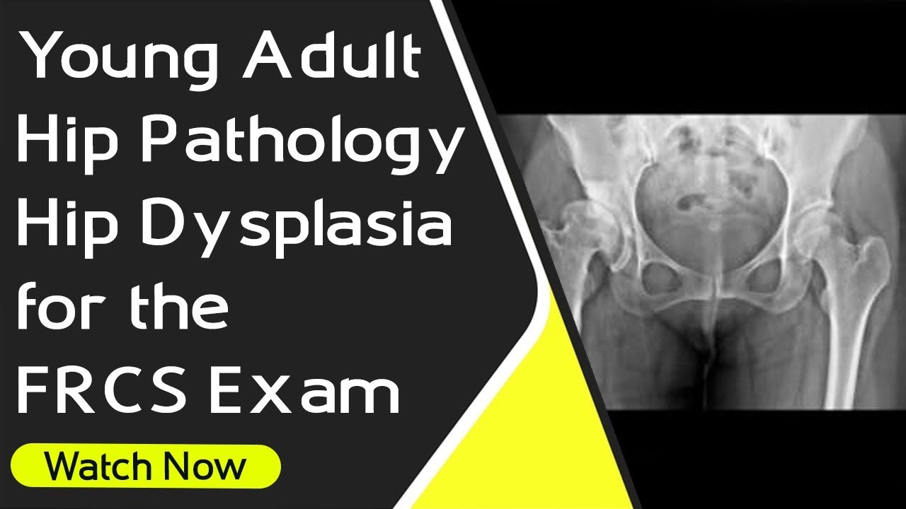 Young Adult  Hip Pathology | Hip Dysplasia for the FRCS Exam | Orthopaedic Academy