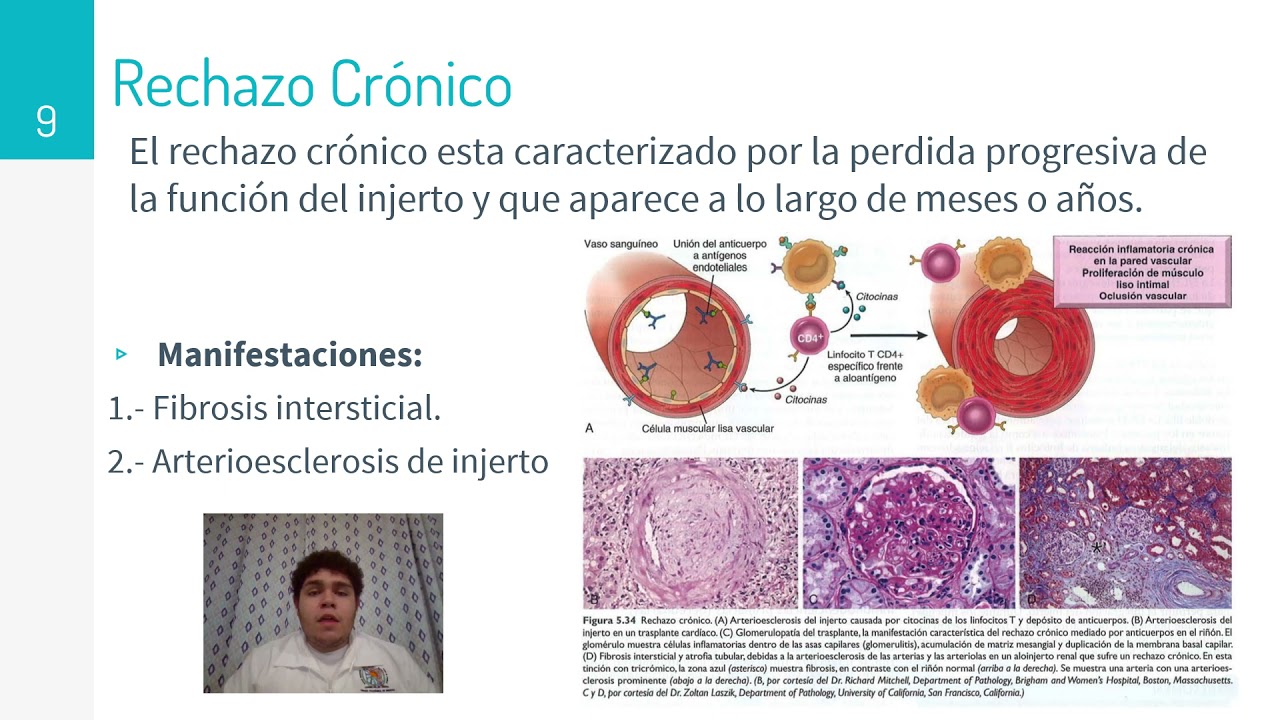 Rechazo de trasplantes - Equipo No. 3 - Patología I