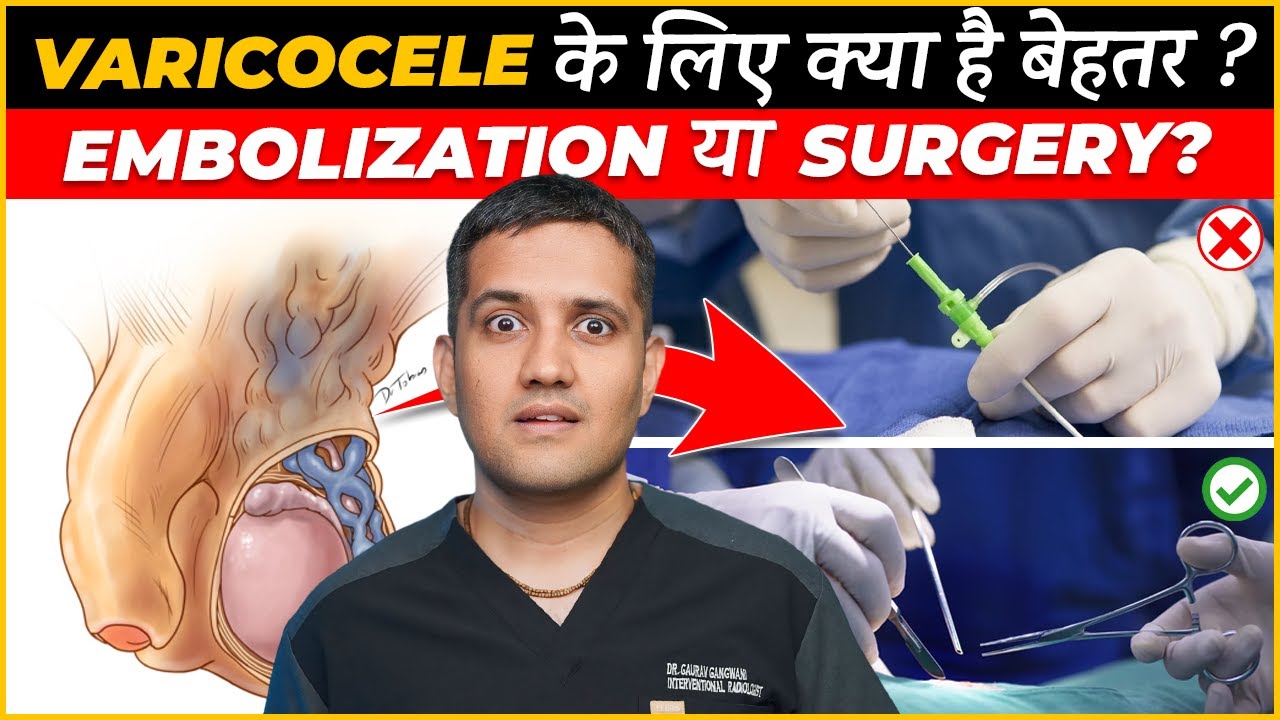 What is better for Varicocele, Embolization or Microsurgery | Dr. Gaurav Gangwani (IR)