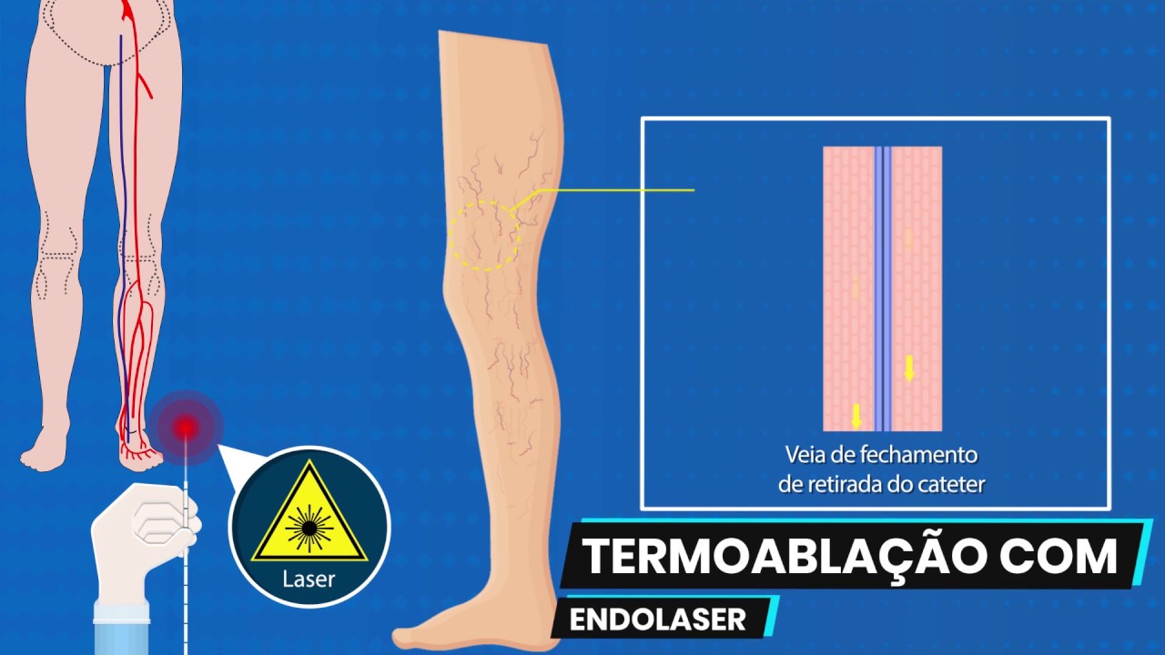 Cirurgia de Varizes - Veia Safena Magna - Tratamentos