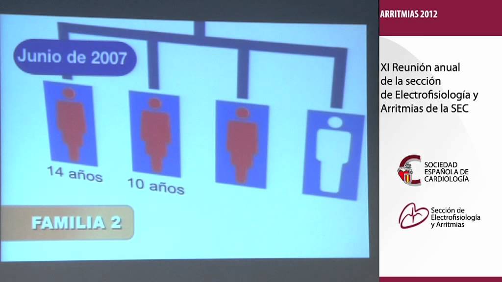 La taquicardia ventricular catecolaminérgica: ¿Una arritmia infradiagnósticada? Dr. Wangüemert
