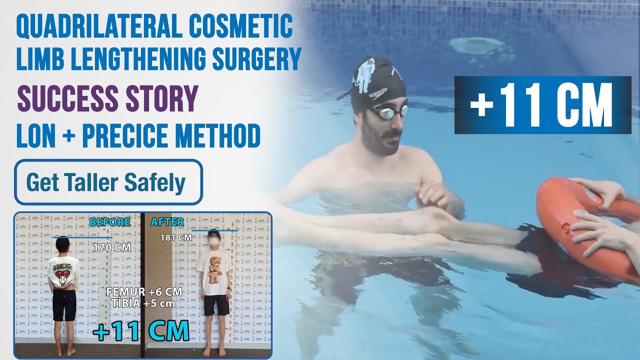 Gained 11 cm with Quadrilateral Limb Lengthening/Precice 2