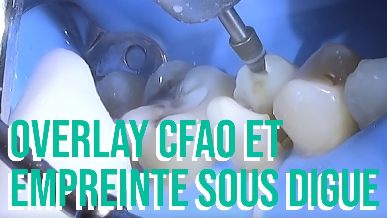Overlay CFAO & Empreinte sous digue, par le Dr Anthony Atlan