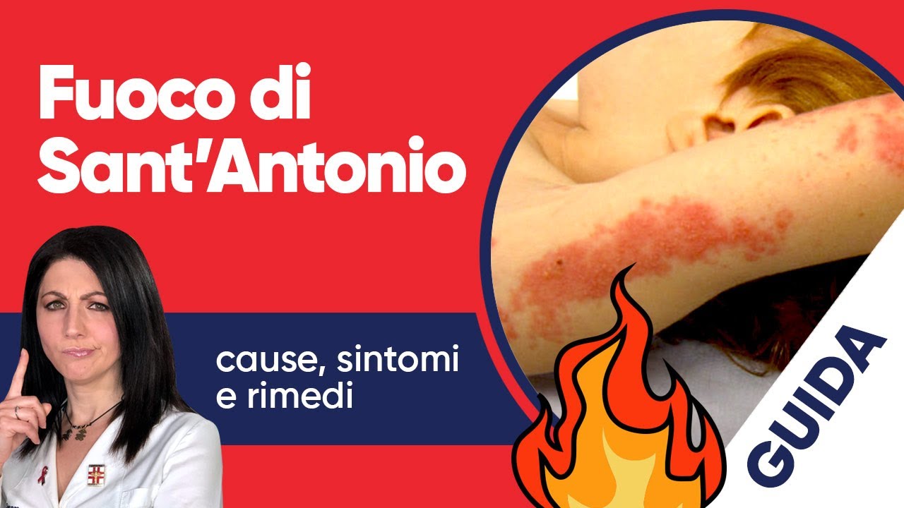 Fuoco di Sant’Antonio: cause, sintomi e rimedi