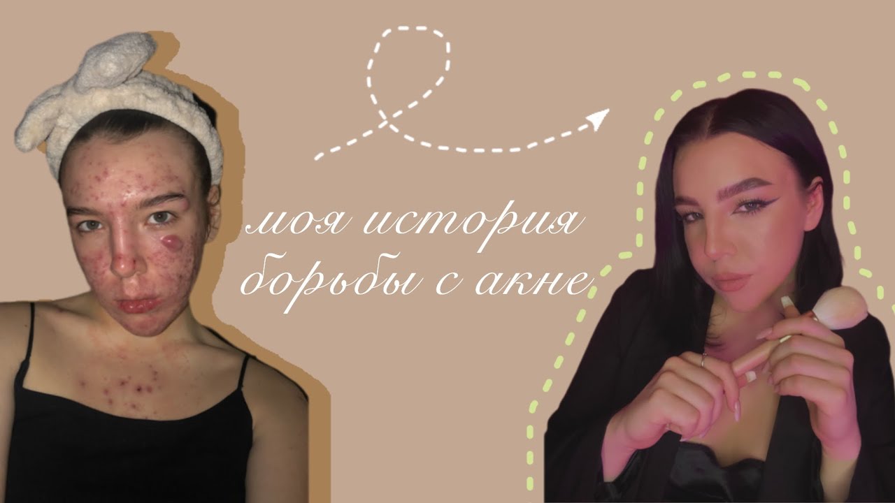 Моя история борьбы с акне.
