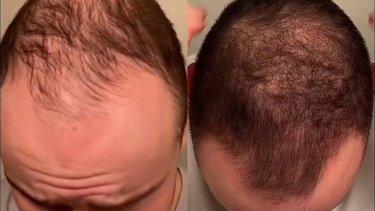 22 month hair journey (from bald to full head of hair)