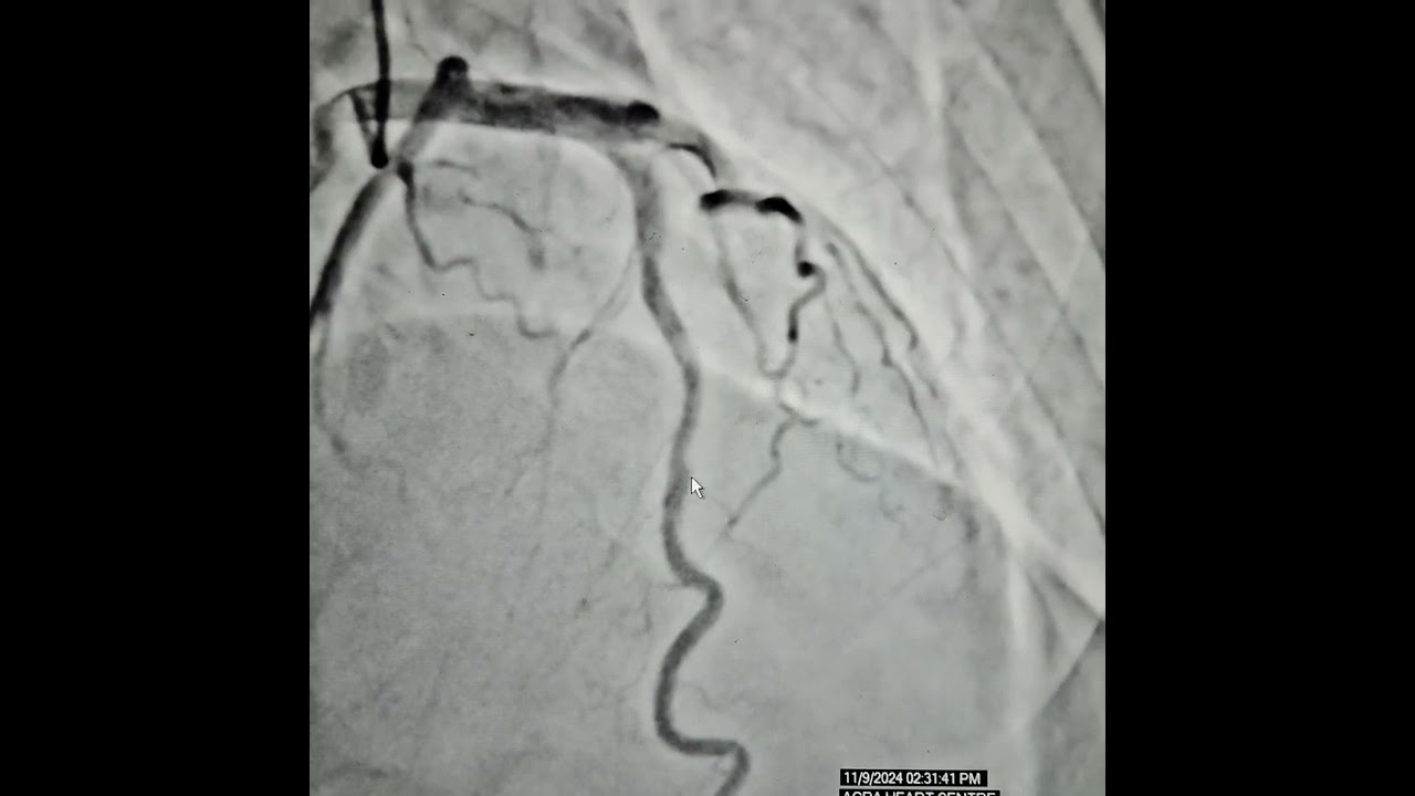 Myocardial Bridge on Angiography | Best Cardiologist in Agra | Dr. Rajat Rawat / Dr. CR Rawat