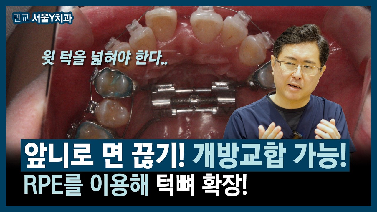 성인 개방교합, 얼굴이 길어 보이는 이유와 교정 접근 | 판교 서울Y치과