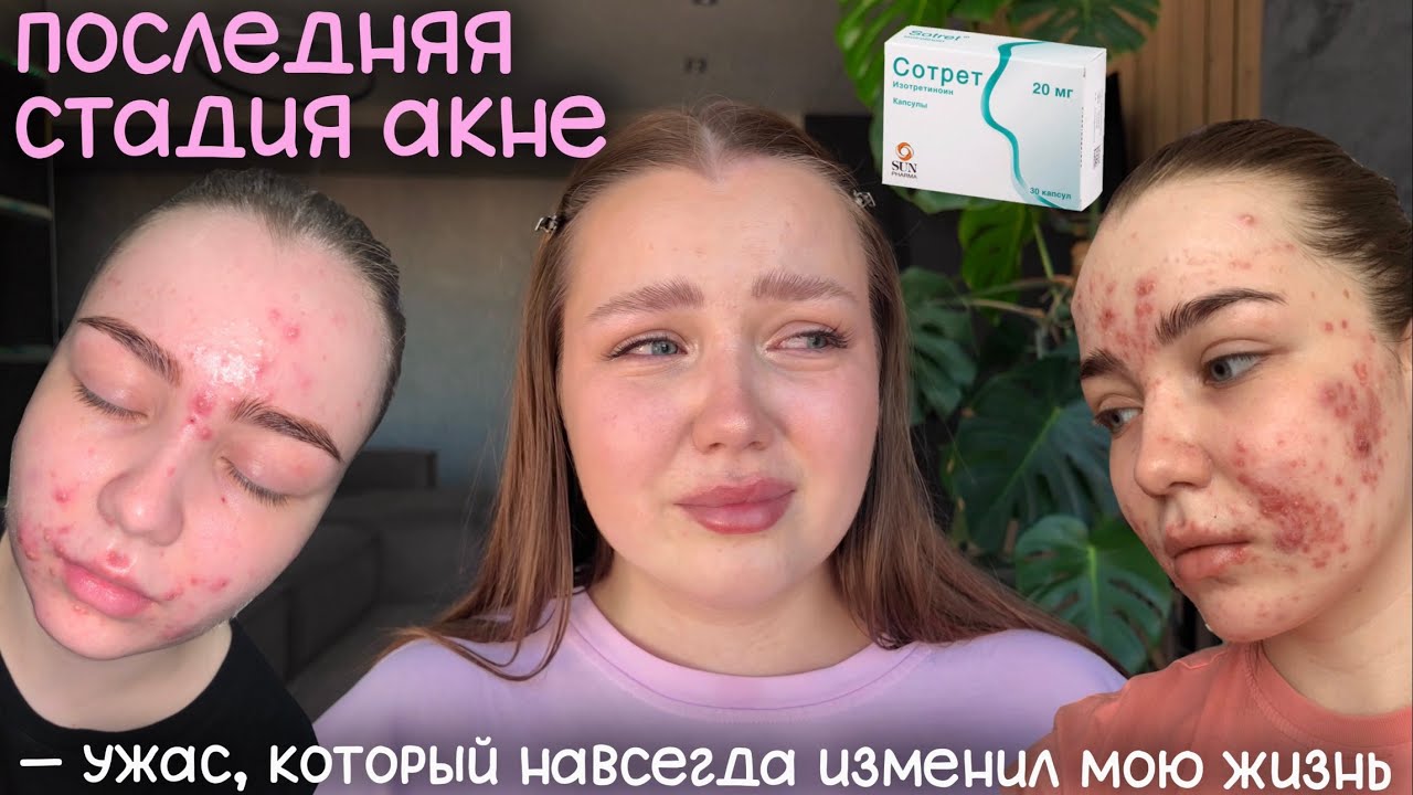 моя история лечения акне | приём ретиноидов | как менялась кожа | ужас, который я не забуду никогда