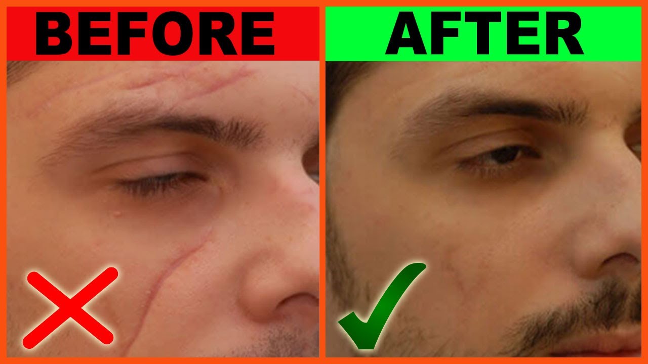 5 Minute DIY Scar Removal at Home | Remove Scars on Face and Body Naturally | No Laser Scar Remove