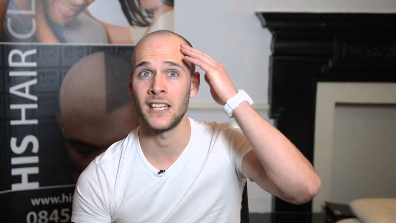 23 Year Old Will has Scalp Micropigmentation at HIS Hair Clinic