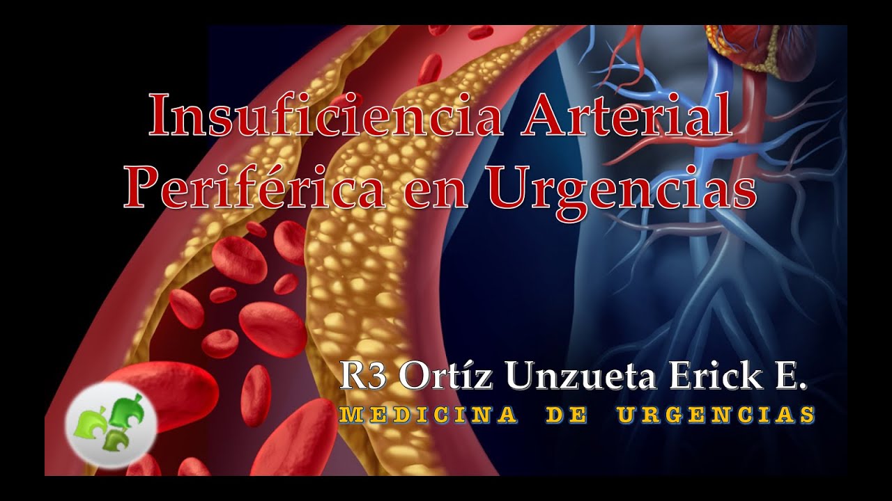 Insuficiencia Arterial Periférica