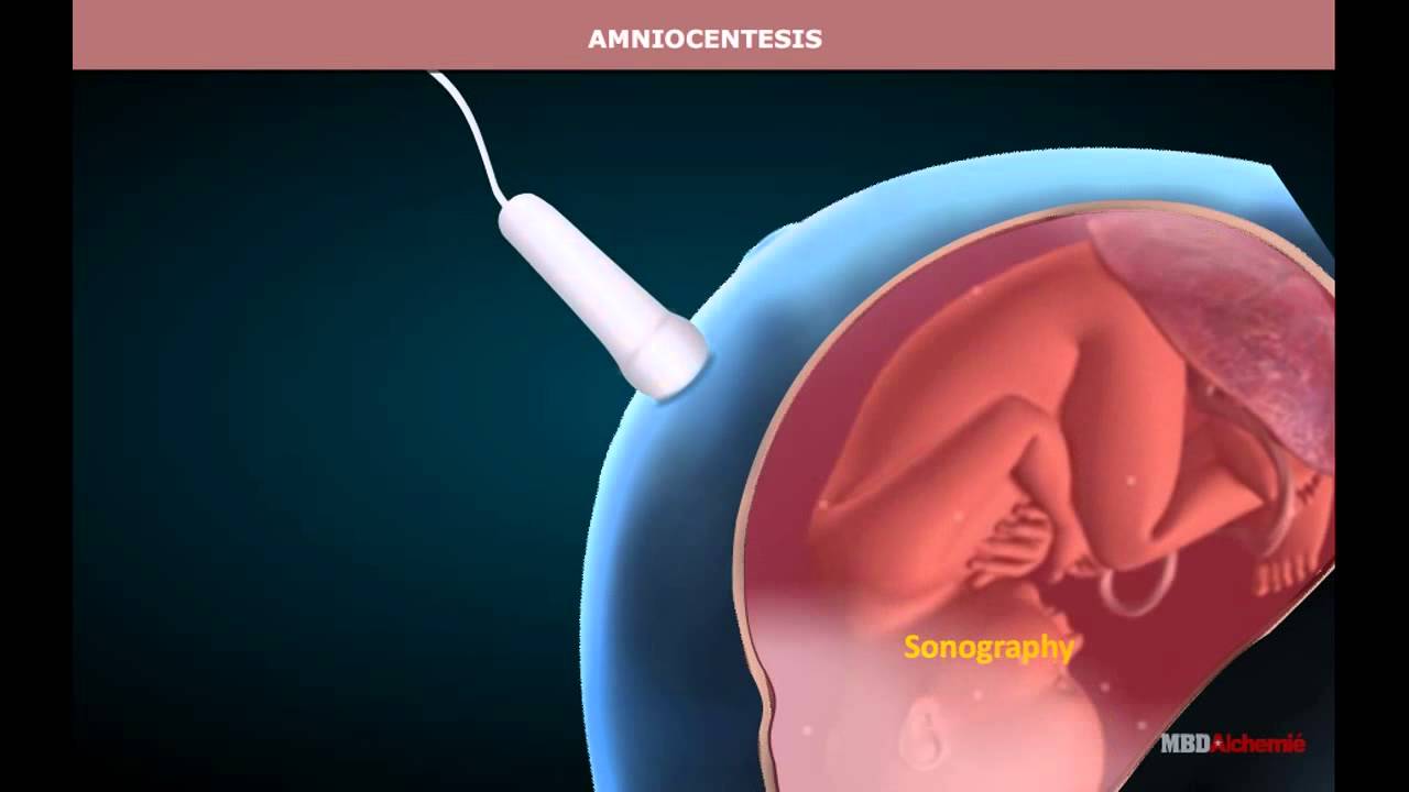 Amniocentesis