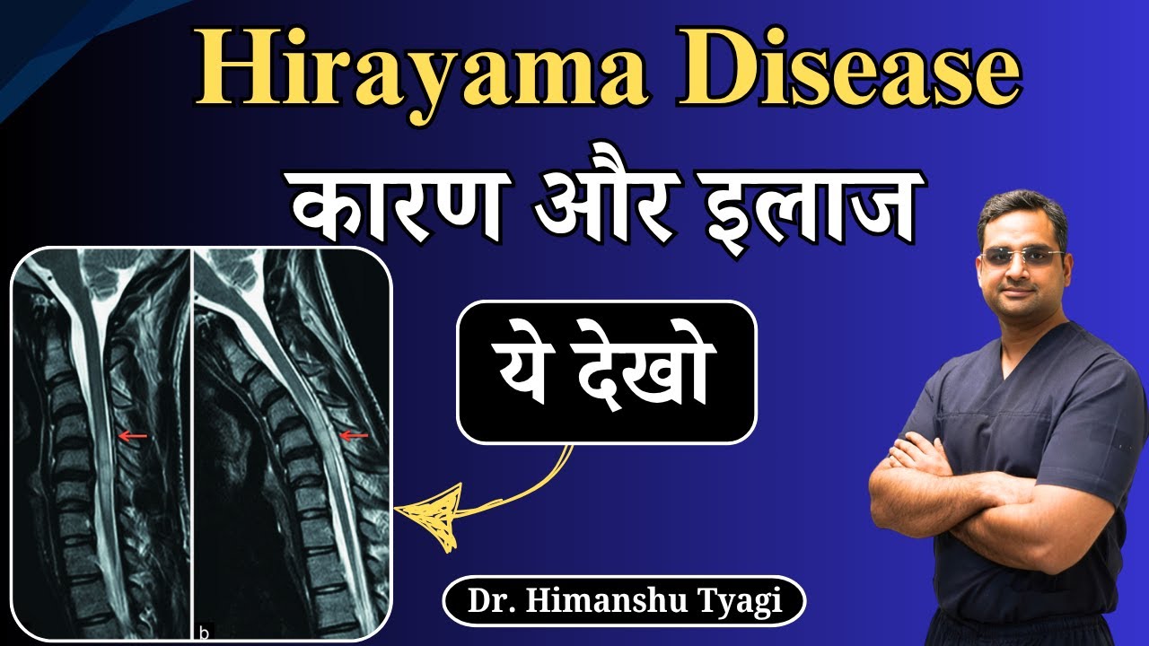 Hirayama Disease कारण और इलाज | Hirayama spine : Treatment & surgery
