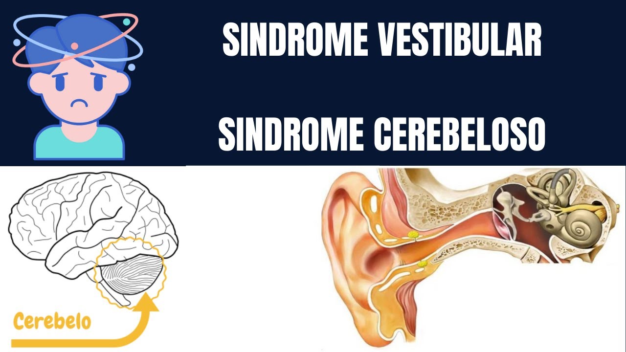 Síndrome vestibular y Síndrome cerebeloso